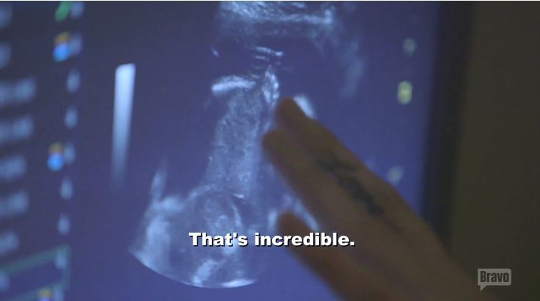 Ultrasound-Flipping-Out