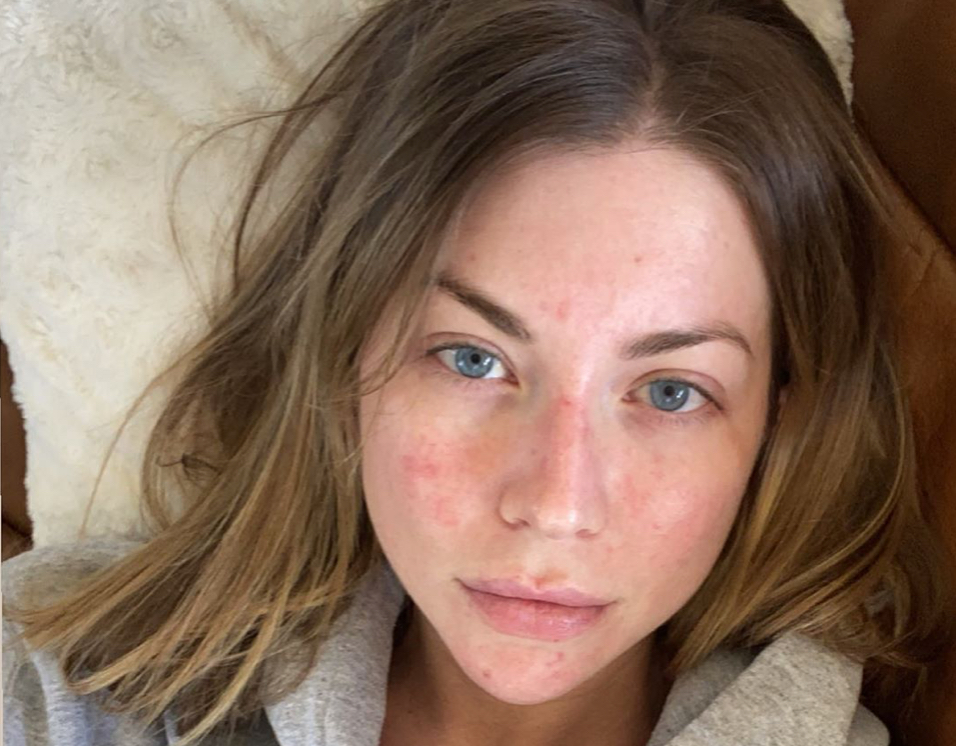 Stassi Schroeder Psoriasis