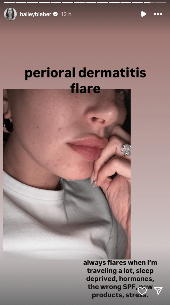 Hailey Bieber dermatitis flare-up