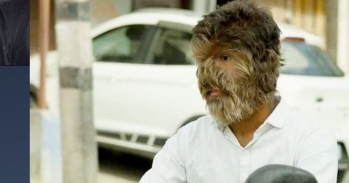 Teen With ‘Werewolf Syndrome’ Praises Barber Who Helped&hellip;